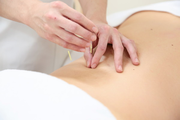 鍼灸のイメージ画像
